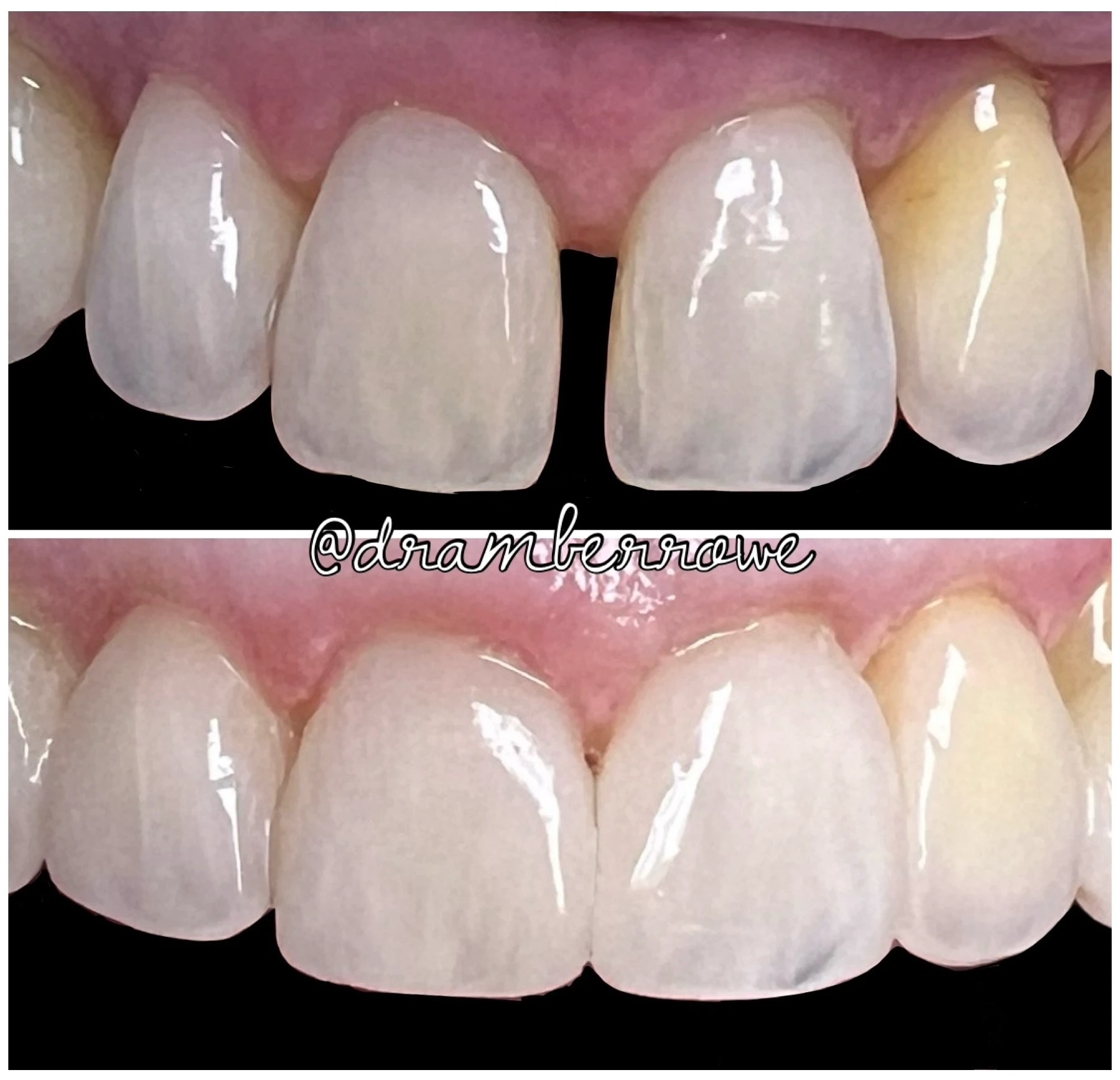 composite-bonding gallery