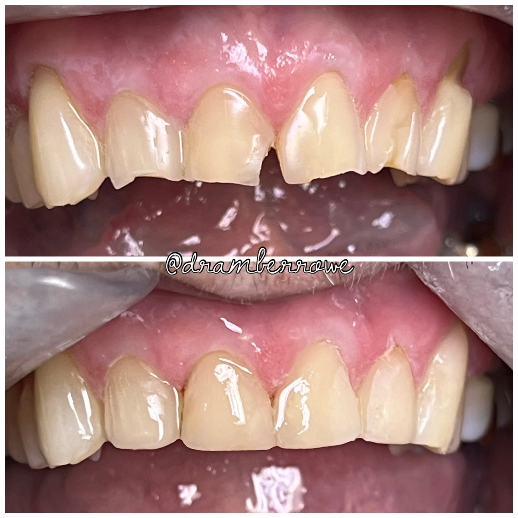 composite-bonding gallery