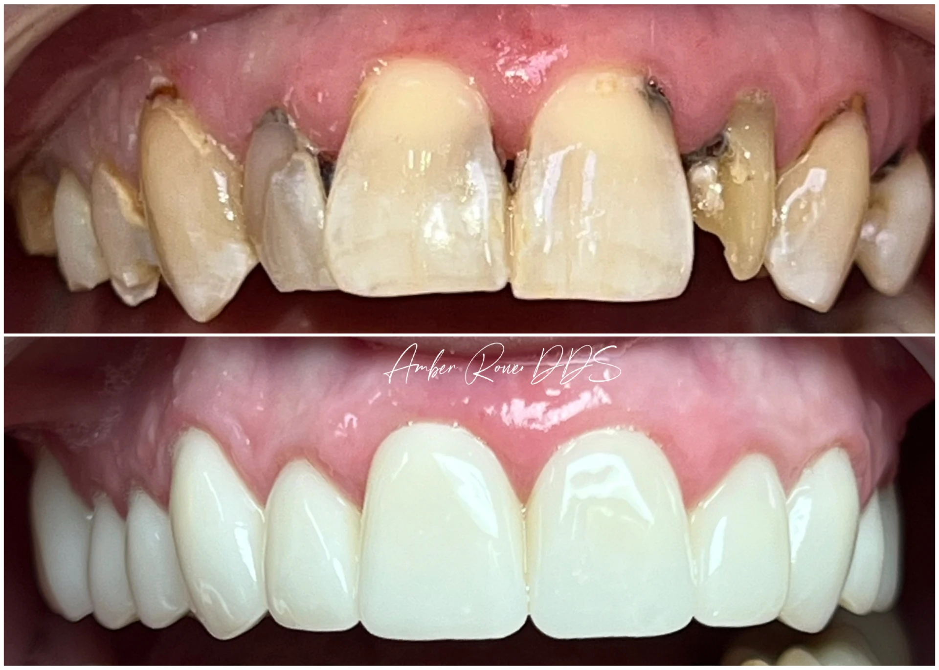 full-mouth-makeover gallery
