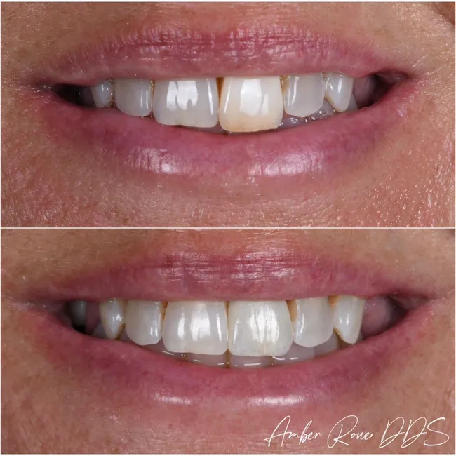 veneers gallery