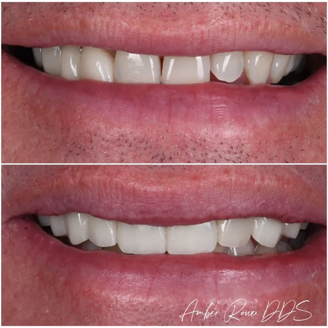 veneers gallery