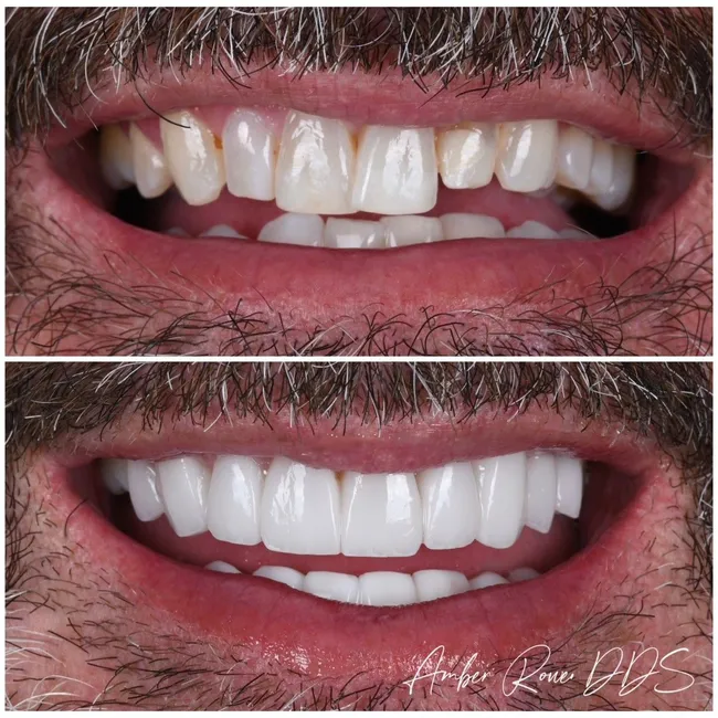 veneers gallery