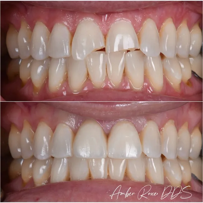 veneers gallery