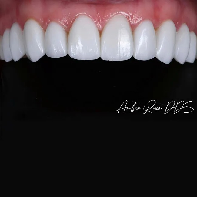 veneers gallery