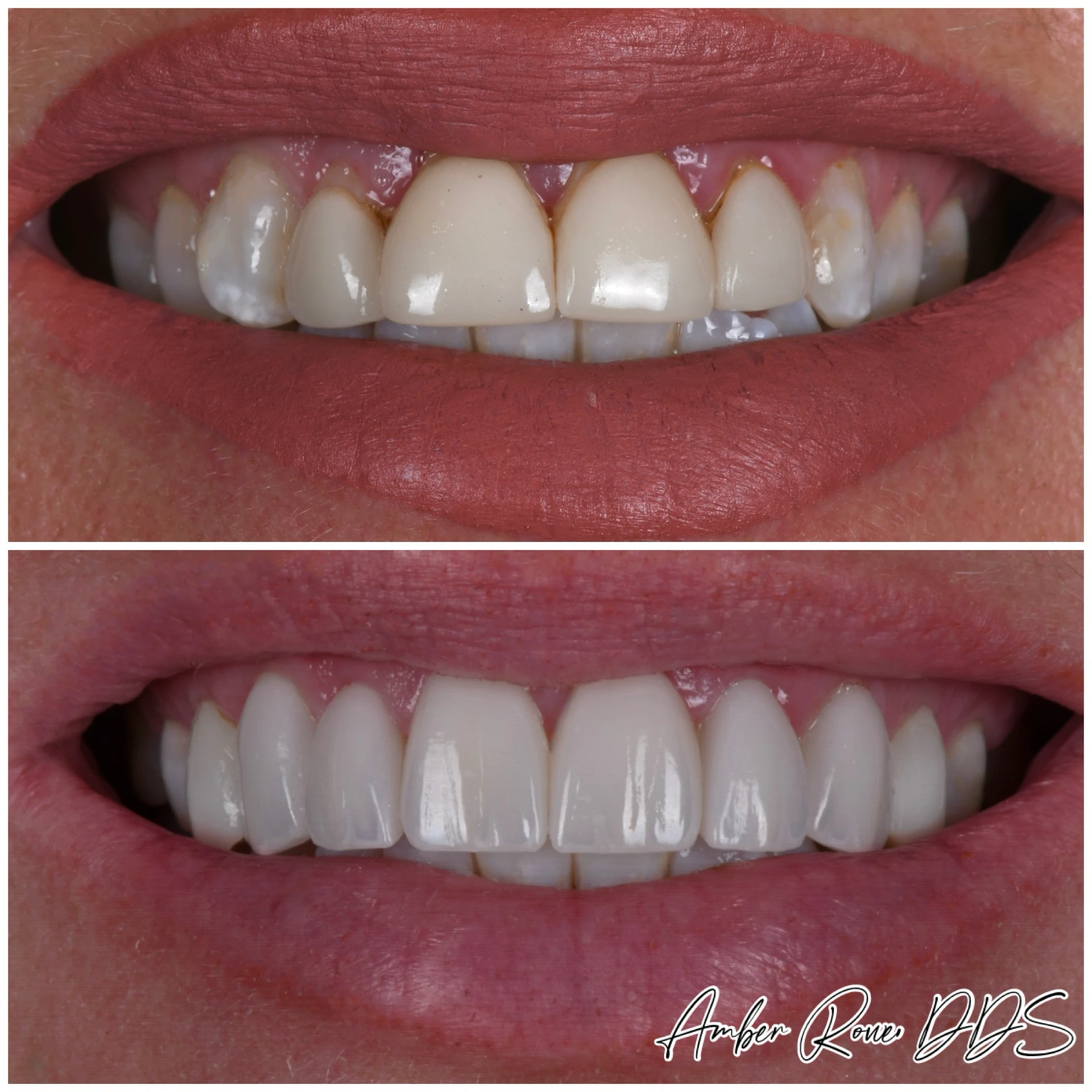 veneers gallery
