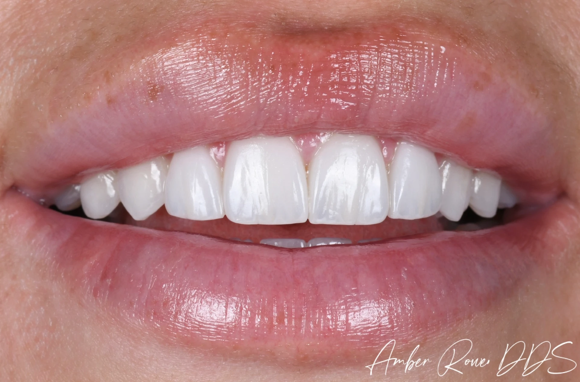 veneers gallery