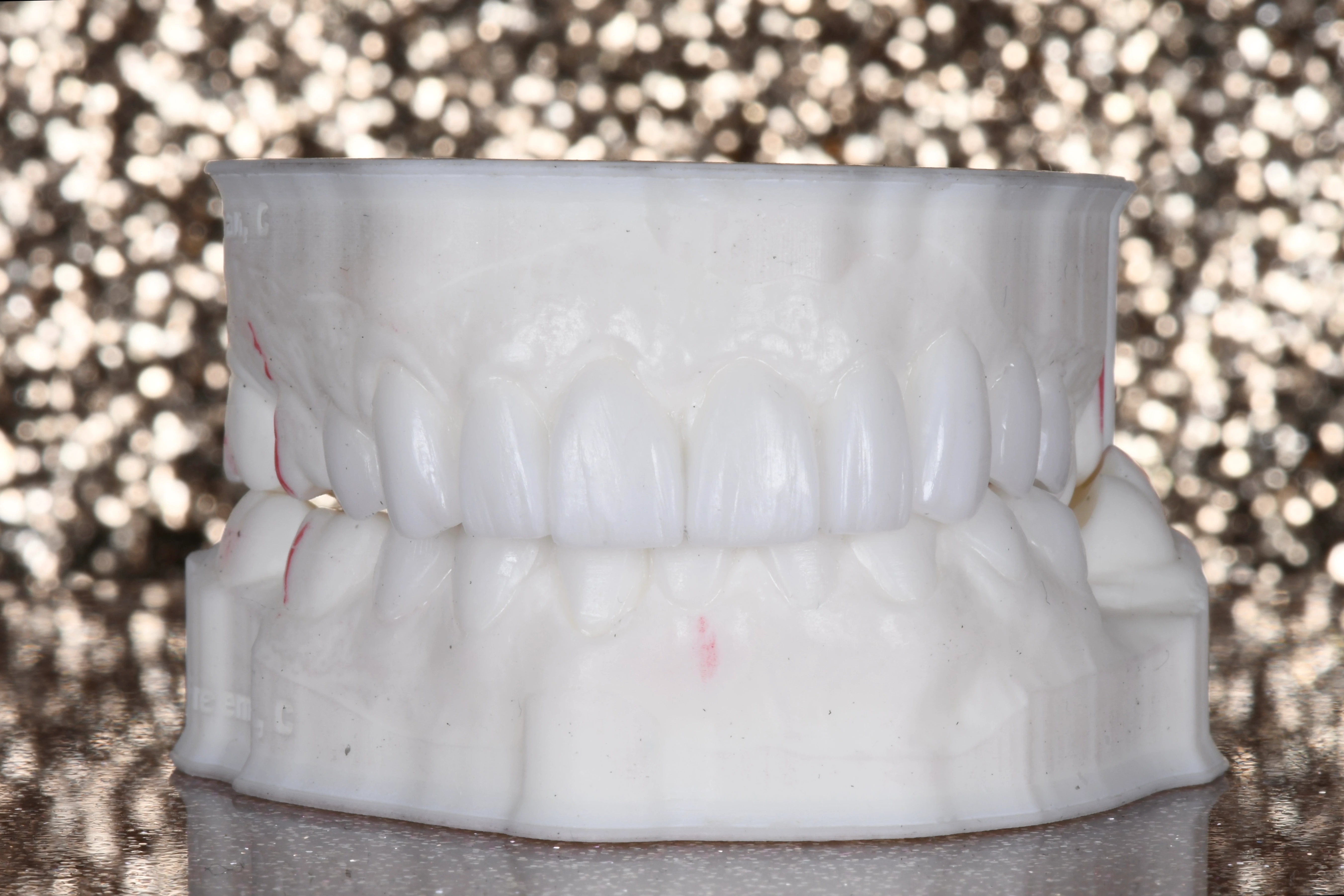 veneers gallery