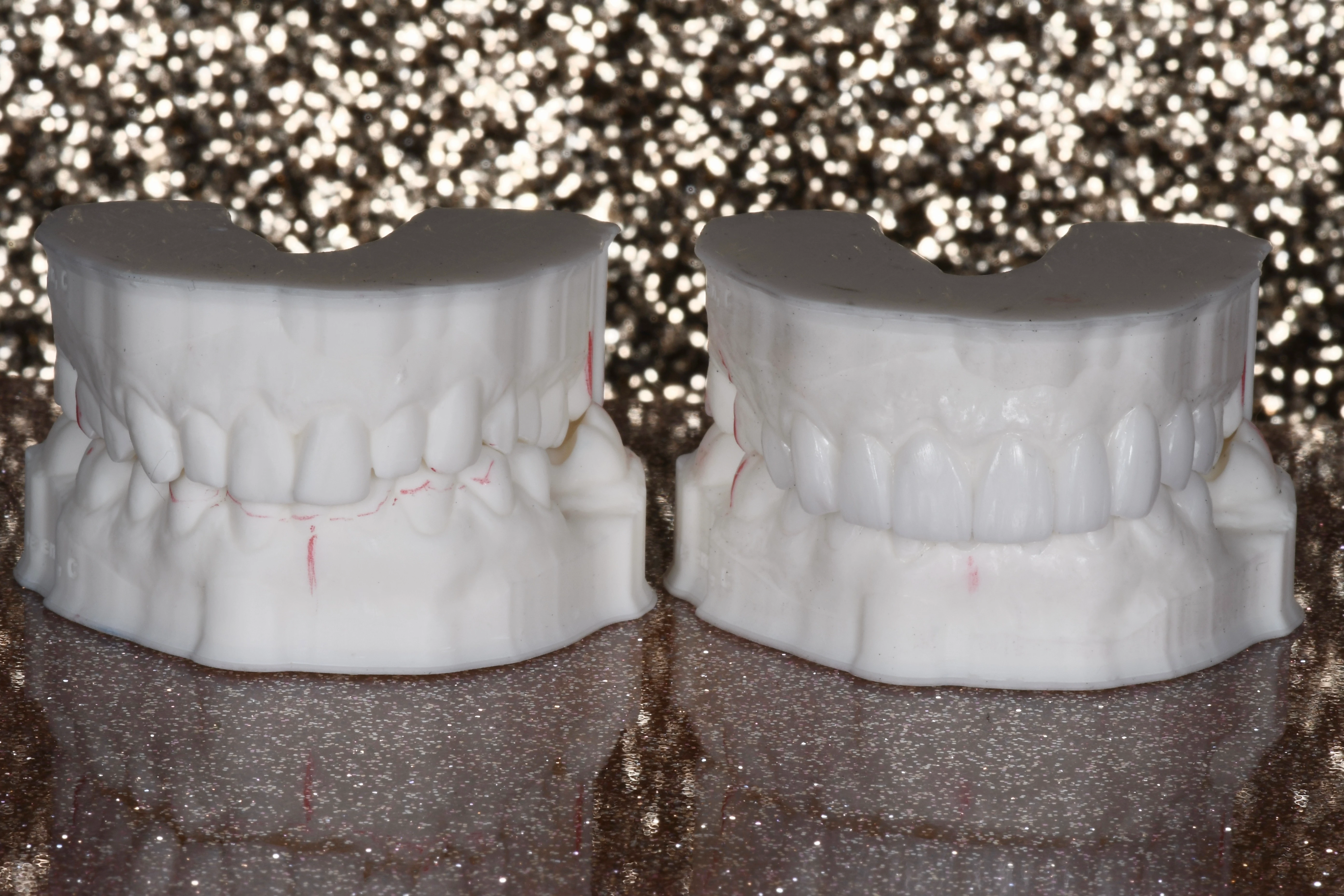 veneers gallery